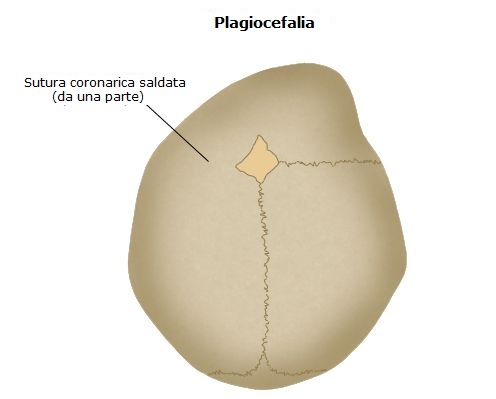 Plagiocefalia Primaria
